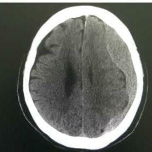 慢性硬膜下血腫